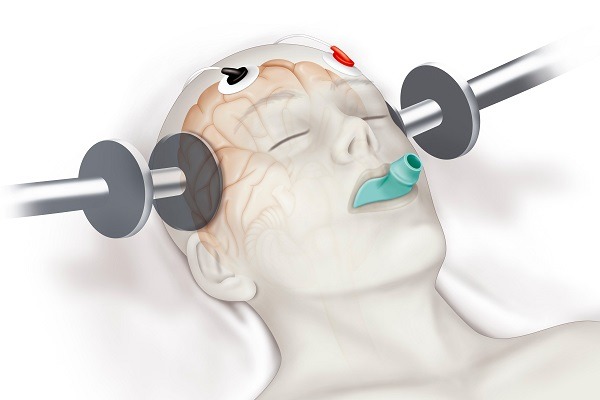 Electroconvulsive Therapy (ECT) Demonstrates High Efficacy in Treating Severe Depression